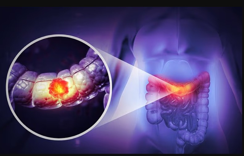 onkologu-paralajmeron-per-nje-simptome-te-nenvleresuar-te-kancerit-te-zorres-ndersa-rastet-te-te-rinjte-po-rriten-ndjeshem